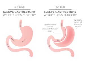 sleeve Gastrectomy